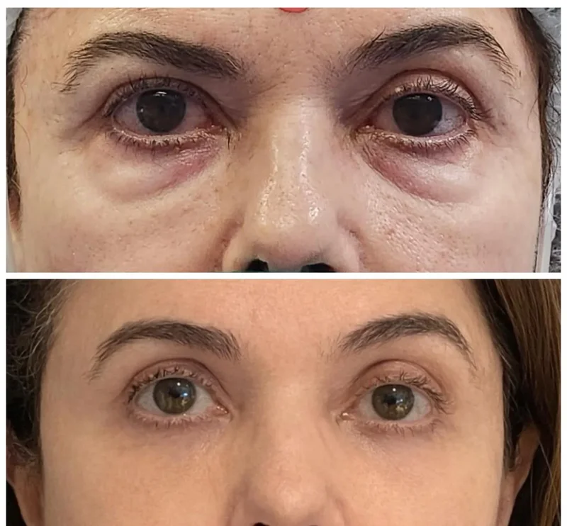Registro clínico de correção de ptose palpebral 1