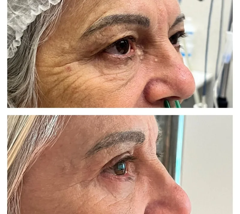 Imagem comparativa de caso real de ptose palpebral 10