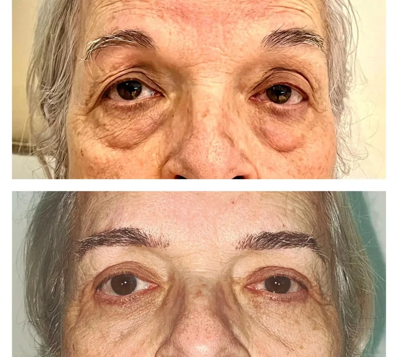 Imagem comparativa de caso real de ptose palpebral 13