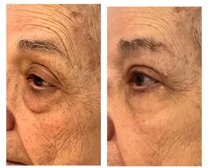 Imagem comparativa de caso real de ptose palpebral 14