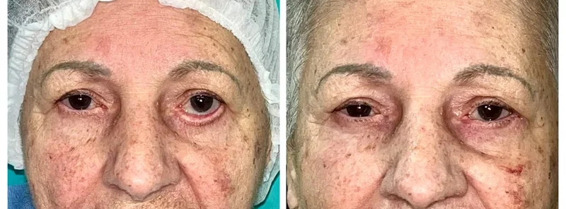 Imagem comparativa de caso real de ptose palpebral 17