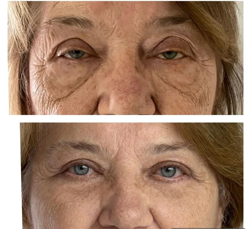 Registro clínico de correção de ptose palpebral 2