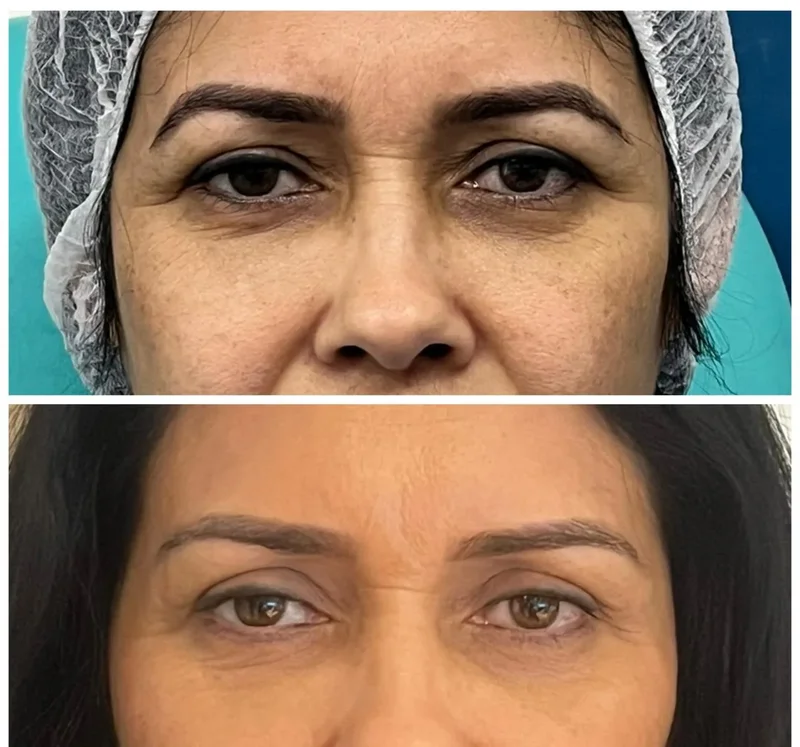 Registro clínico de correção de ptose palpebral 4