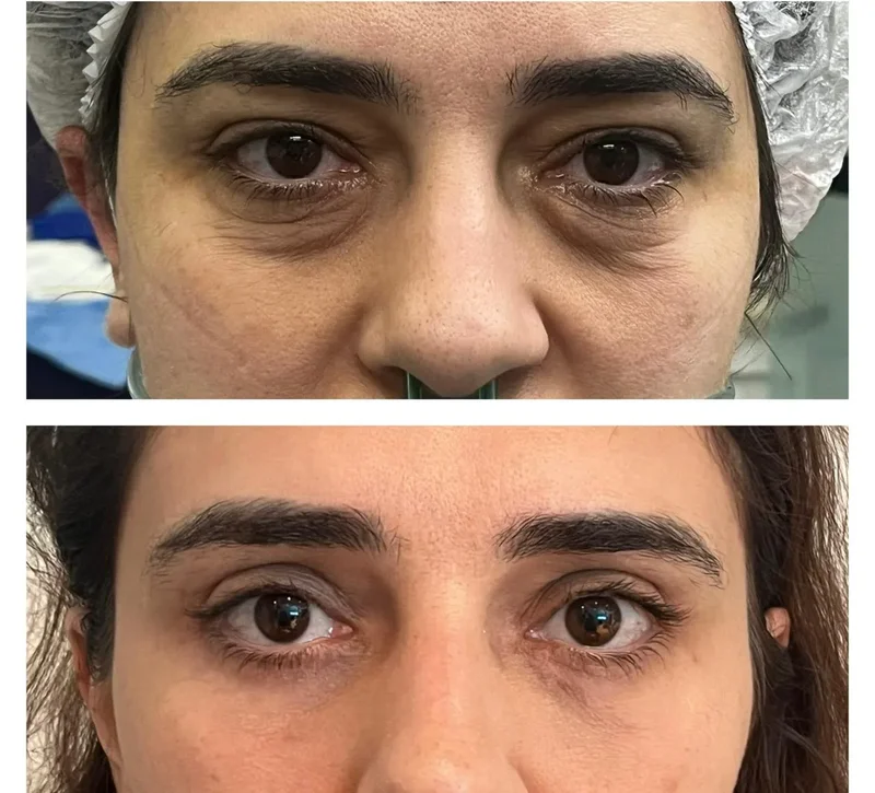 Imagem comparativa de caso real de ptose palpebral 9