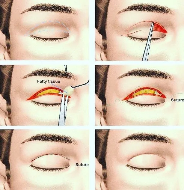 Resultado Blefaroplastia
